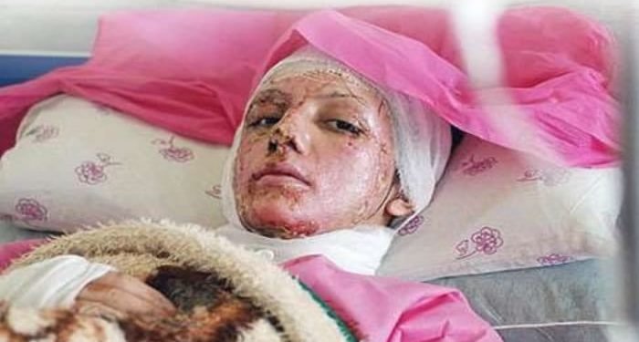 وحشیة قصوی: هجمات برش الحامض علی النساء بذریعة سوء التحجب