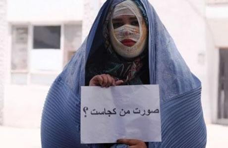 إيران: رش الحامض على فتاة شابة من مدينة تبريز