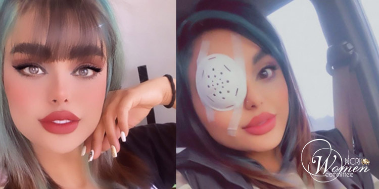 نساء إيران الشجعان قد تُعميهن برصاصة كروية، لكن قلوبهن ما زالت تنبض