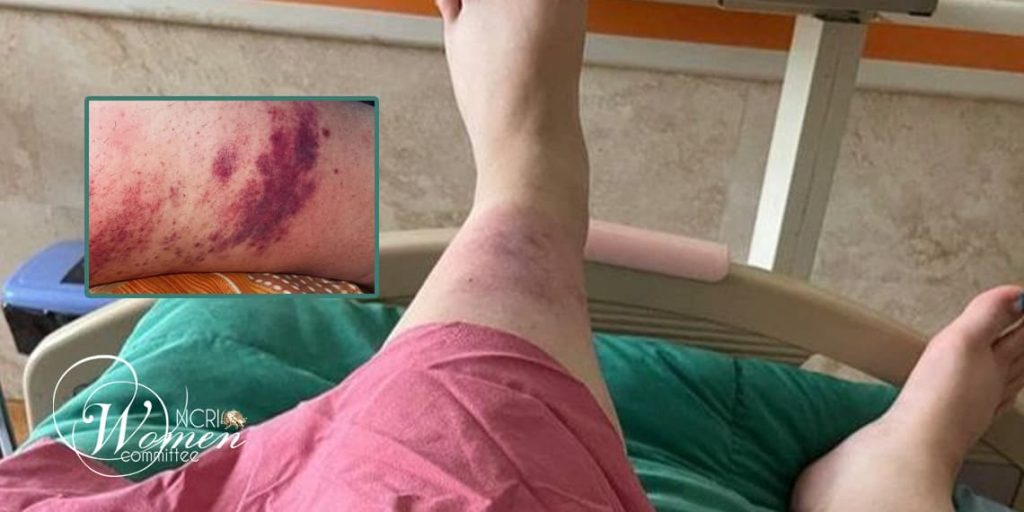 يمكن رؤية العدوى على ساق سارا دلدار 