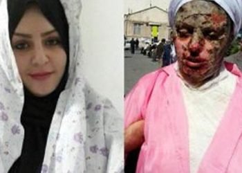 Young woman was splashed by acid in Tabriz